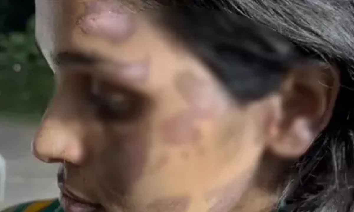 पत्नी को जलाया, बंधक बनाकर रखा पति गिरफ्तार; ससुराल पक्ष की भूमिका की जांच जारी