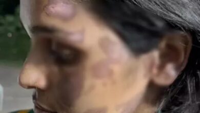 पत्नी को जलाया, बंधक बनाकर रखा पति गिरफ्तार; ससुराल पक्ष की भूमिका की जांच जारी