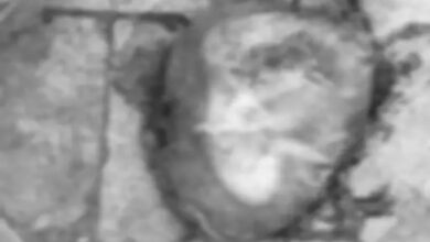 मेकाहारा रायपुर में कचरे के पास मिला भ्रूण: दो संदिग्ध CCTV में कैद, पुलिस जांच में जुटी