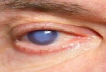 Cataract surgery negligence again! Nine patients in Bijapur have severe eye infections, one requires a cornea transplant.