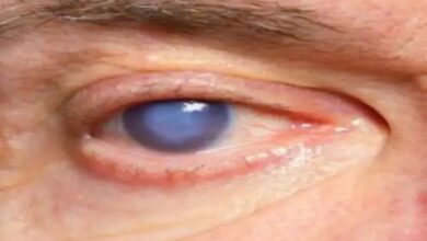 Cataract surgery negligence again! Nine patients in Bijapur have severe eye infections, one requires a cornea transplant.