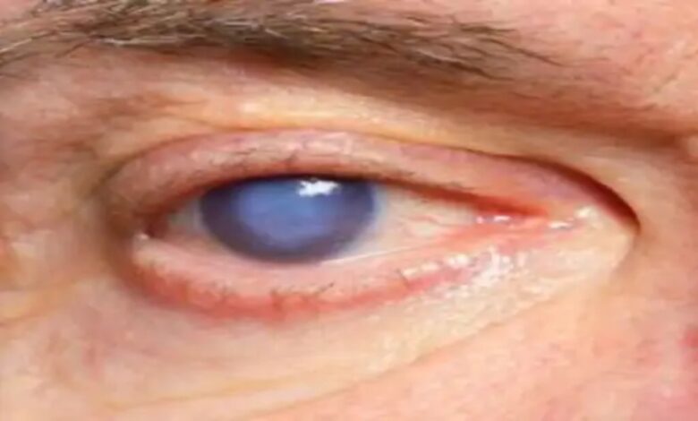 Cataract surgery negligence again! Nine patients in Bijapur have severe eye infections, one requires a cornea transplant.