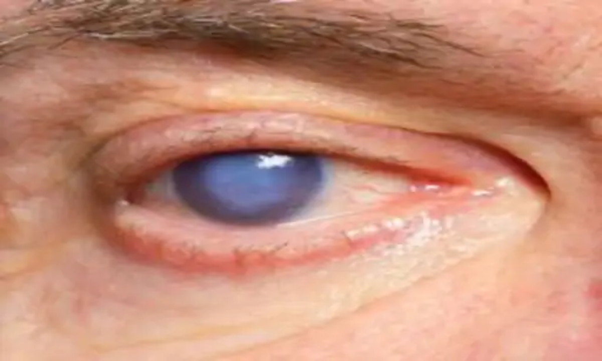 Cataract surgery negligence again! Nine patients in Bijapur have severe eye infections, one requires a cornea transplant.