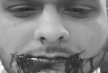 Chinese kite string wreaks havoc: Student's cheek cut in Raipur, requires 34 stitches, video goes viral.