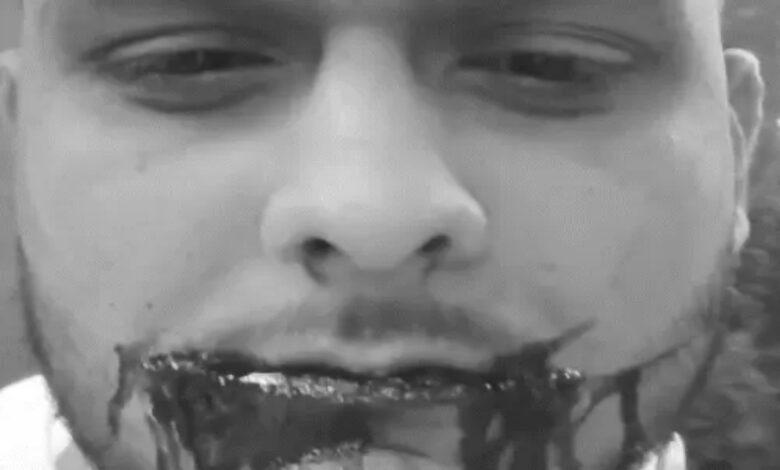 Chinese kite string wreaks havoc: Student's cheek cut in Raipur, requires 34 stitches, video goes viral.