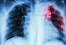 The risk of tuberculosis is higher in densely populated areas.