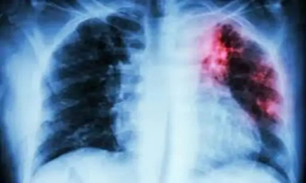 The risk of tuberculosis is higher in densely populated areas.