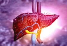 World Liver Day: The Threat Is Rising Due to Poor Lifestyle—Not Just Alcohol, But Junk Food Is Also to Blame.