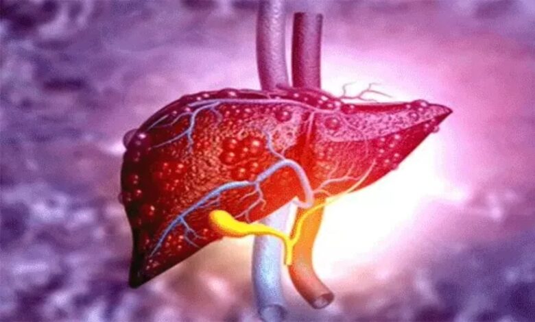 World Liver Day: The Threat Is Rising Due to Poor Lifestyle—Not Just Alcohol, But Junk Food Is Also to Blame.