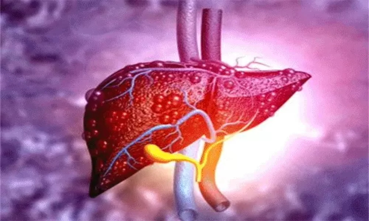 World Liver Day: The Threat Is Rising Due to Poor Lifestyle—Not Just Alcohol, But Junk Food Is Also to Blame.