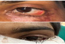 Successful Reconstruction of Eyelid via Skin Grafting; Young Man Regains Sight