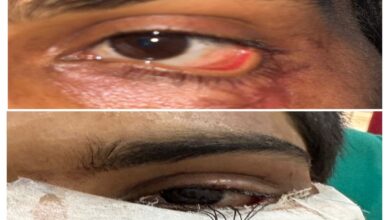 Successful Reconstruction of Eyelid via Skin Grafting; Young Man Regains Sight