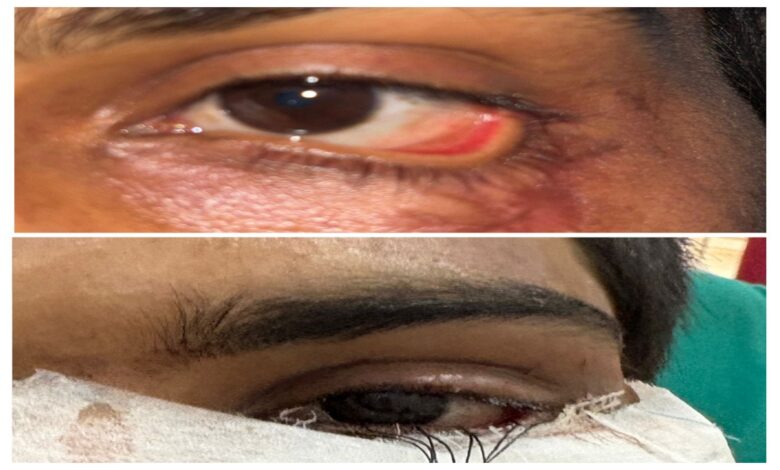 Successful Reconstruction of Eyelid via Skin Grafting; Young Man Regains Sight